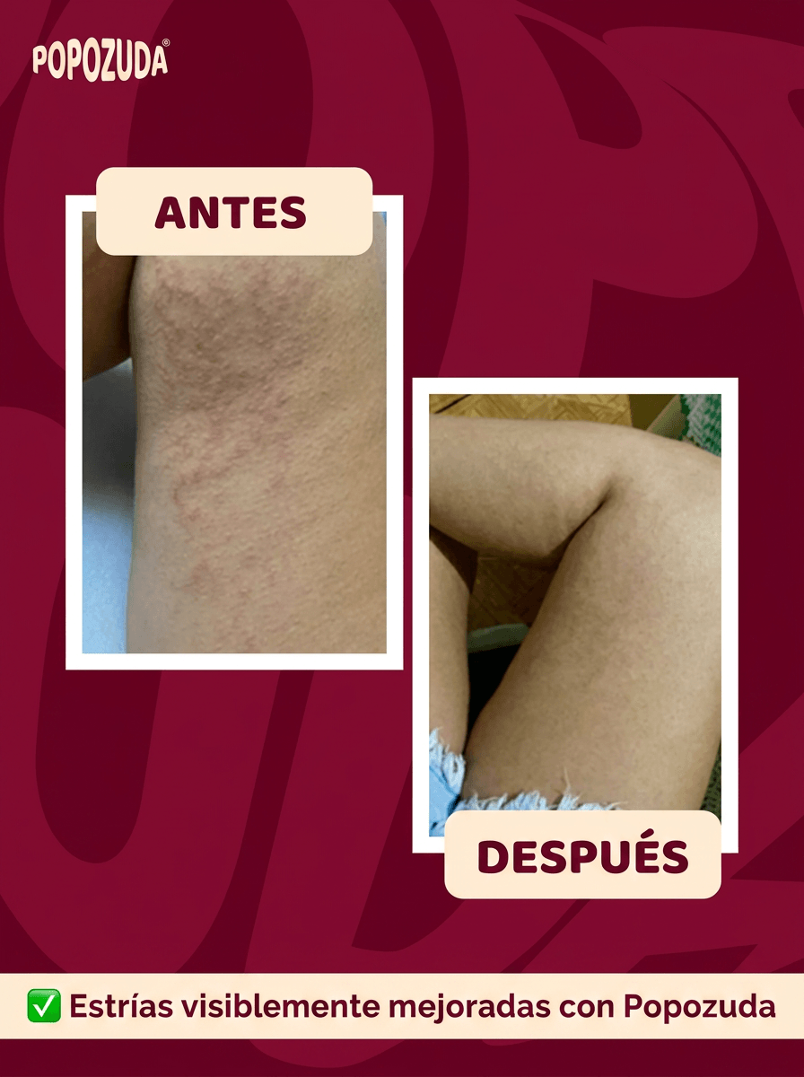 POPOZUDA AYUDA A ELIMINAR CELULITIS Y ESTRÍAS
