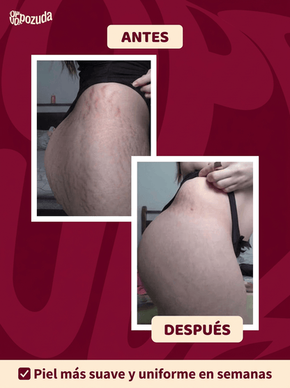 POPOZUDA AYUDA A ELIMINAR CELULITIS Y ESTRÍAS