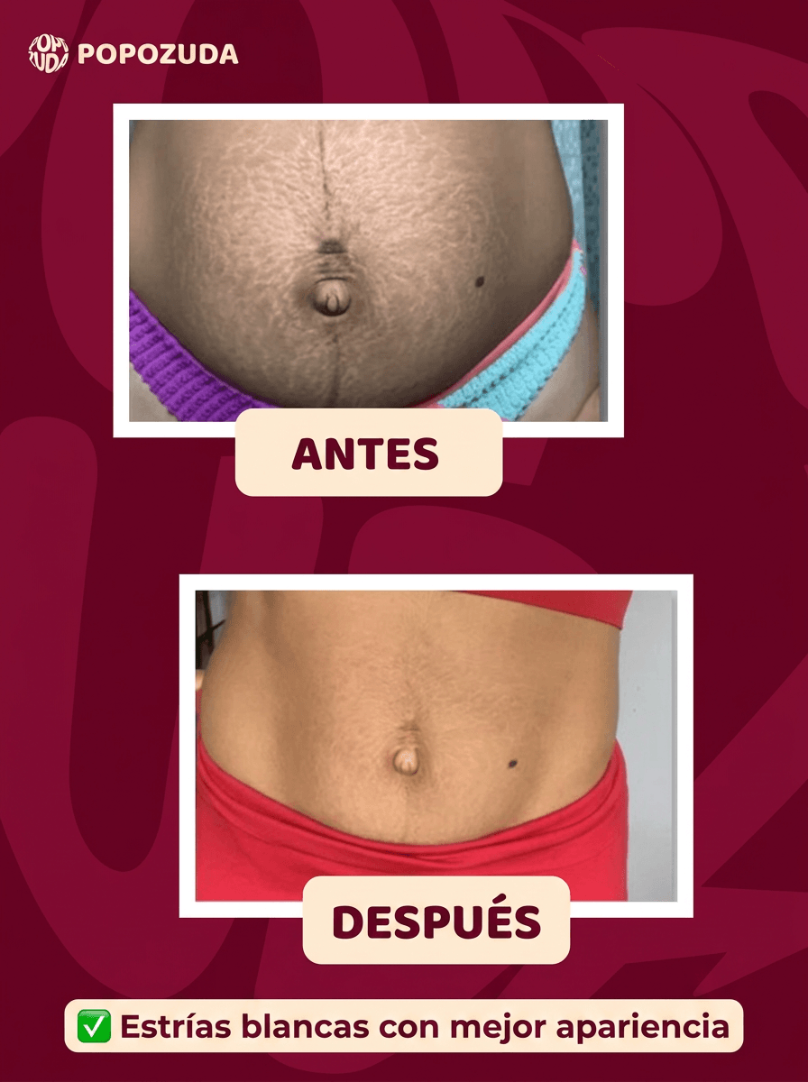 POPOZUDA AYUDA A ELIMINAR CELULITIS Y ESTRÍAS