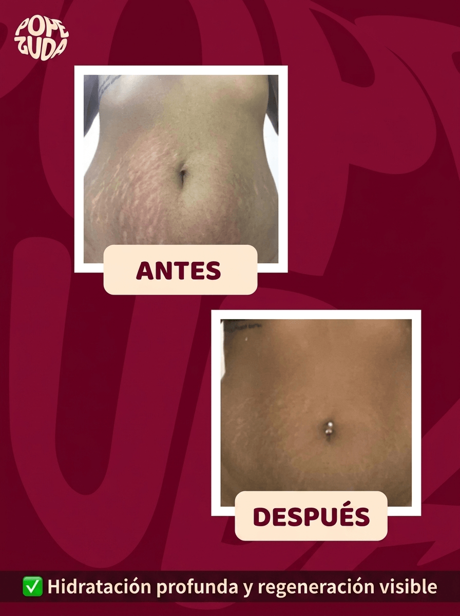 POPOZUDA AYUDA A ELIMINAR CELULITIS Y ESTRÍAS