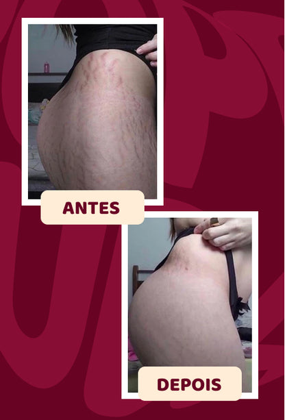 POPOZUDA ELIMINA CELULITIS Y LIPEDEMA