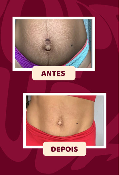 POPOZUDA ELIMINA CELULITIS Y LIPEDEMA